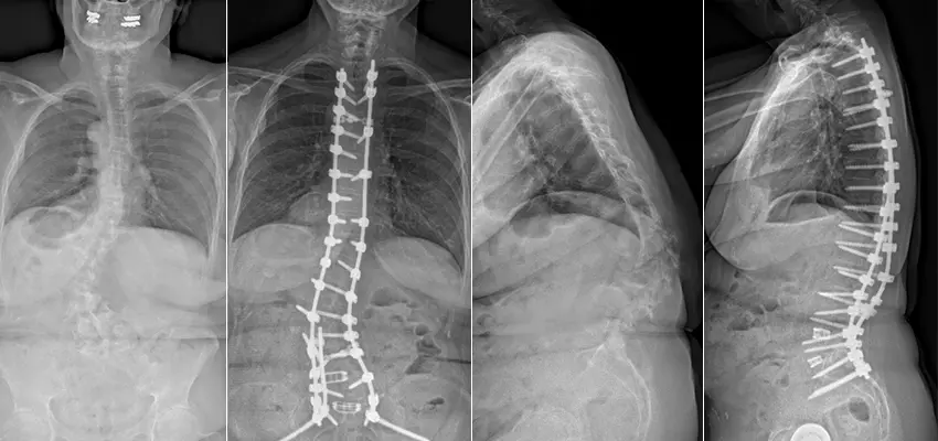 Peggy's X-rays before and after spine surgery for scoliosis and kyphosis