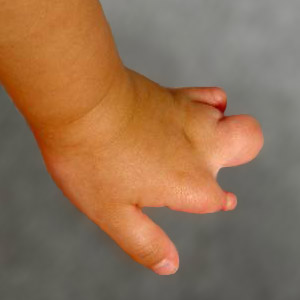 amniotic band syndrome toes