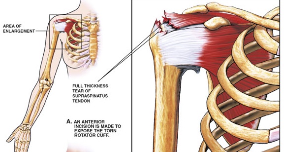 Concerns about rotator cuffs - why operate?