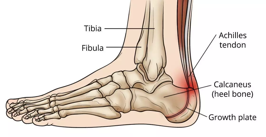 heel pain after broken ankle